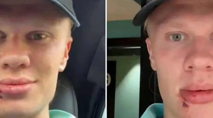 Халанд со бизарна повреда, го удри врата од автобус